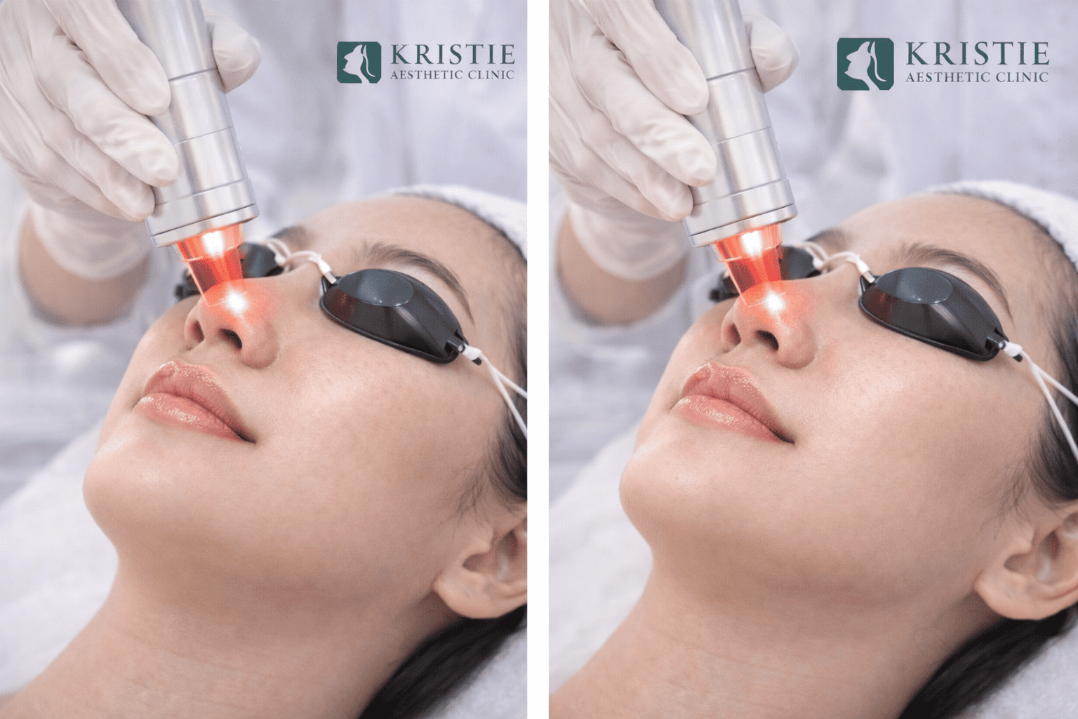 Pori-Pori Besar Bikin Wajah Kusam? Ini Cara Efektif Memudarkannya